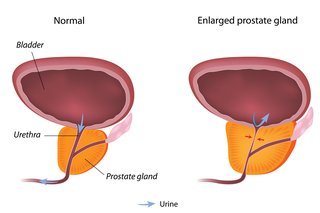 Prostate BPH